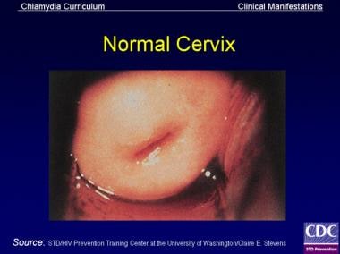 cervix with chlamydia