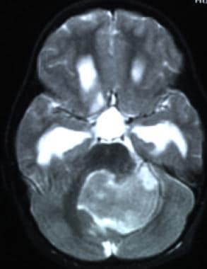 T2-weighted MRI demonstrating ependymoma in the fo
