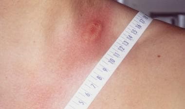 Lyme disease. Photo of the left side of the neck o