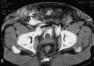 CT scan of extraperitoneal bladder rupture. The co