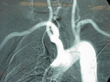 Arteriogram of aortic arch demonstrating (1) brach
