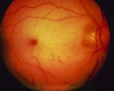 central retinal artery occlusion vs normal