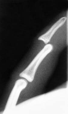 Lateral view of distal interphalangeal (DIP) joint
