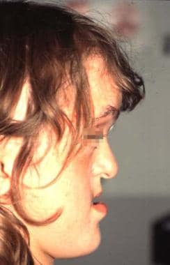 Lateral view of a patient with Apert syndrome. Not
