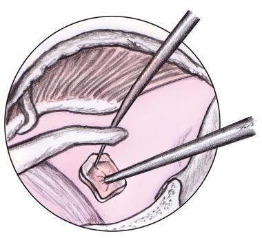 一块组织(筋膜、软骨膜或静脉)