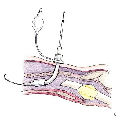 Percutaneous dilatational tracheotomy (PDT techniq