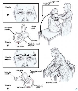 The Different Types of Vertigo & Their Common Causes