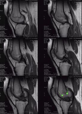 剥脱性骨软骨炎的侧位MRI。