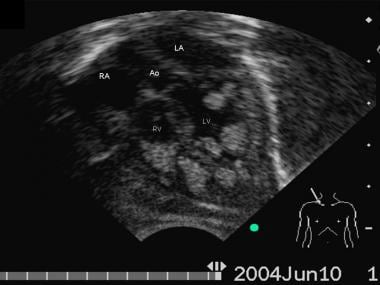 Echocardiographic apical 5 chamber view of a 1 mon