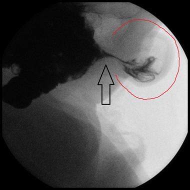 Upper gastrointestinal contrast study showing inci