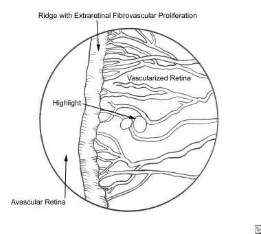 Retinopathy of Prematurity. Stage III retinopathy 