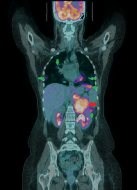 Coronal fused 18F-FDG PET/CT image of a 27-year-ol