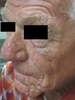 Cutaneous Manifestations of Smoking