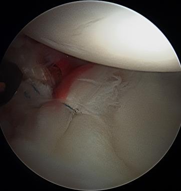 Hip arthroscopy. First anchor placed for labral re