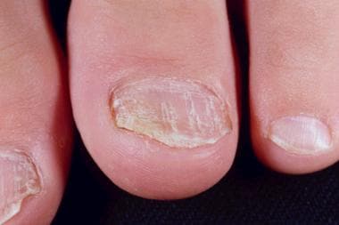 psoriasis on fingernails