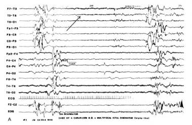 Multifocal electrographic seizure in a curarized i