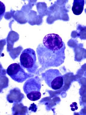 Osteoblasts in cytologic preparation (Diff-Quik st