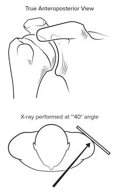 The diagnosis of shoulder osteoarthritis (OA) is m