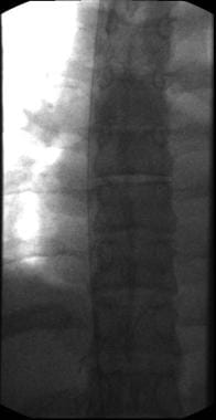 Fluoroscopy with wire in superior vena cava. 