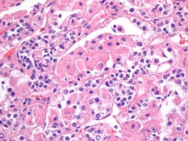 Transcription factor EB (TFEB) renal cell carcinom