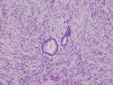 Стромальная саркома. Эндометриальная стромальная саркома матки. Эндометриальная стромальная саркома гистология. Стромальная саркома матки гистология. Эндометриальная саркома матки гистология.