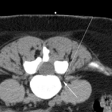 CT scan from a scout series prior to a lumbar nerv