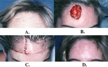 Rotation flaps. A: Large basal cell carcinoma of t
