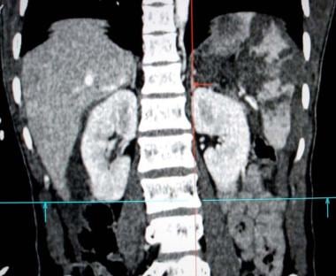 CT scan of abdomen showing grade IV splenic injury