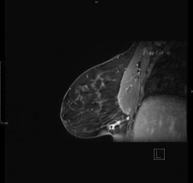 Same patient as in the previous mammogram: Reconst