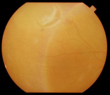 Patient with a rhegmatogenous retinal detachment s