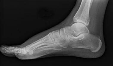 足部外侧x光片。
