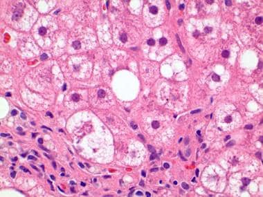 Higher magnification shows ballooned hepatocytes a