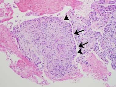 A case of hot tub lung in a 48-year-old woman with