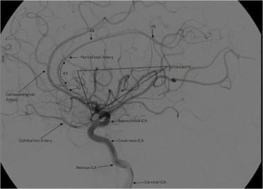 Lateral view of a cerebral angiogram illustrates t