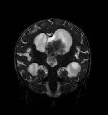 choroid plexus papilloma medscape