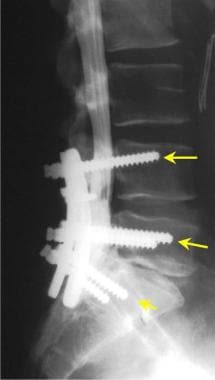 Lateral view of a lumbar myelogram performed in a 