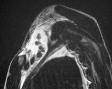 Avulsion in a 15-year-old male adolescent with pal