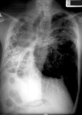 Cystic fibrosis, thoracic. Patient with a history 