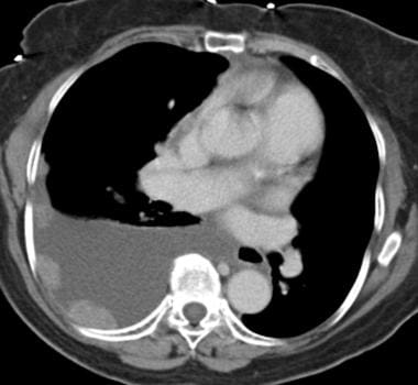 Axial CT scan in a patient with breast cancer show