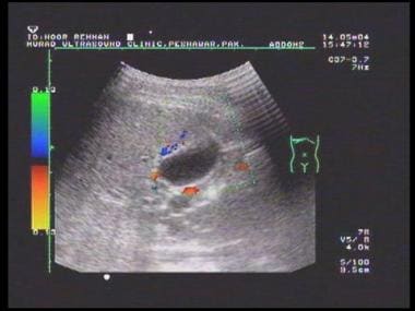 Color Doppler ultrasound showing pericholecystic v