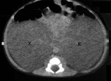 Autosomal recessive polycystic kidney disease (ARP