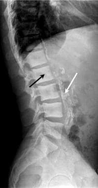 Lateral radiograph of the lumbar spine in renal fa