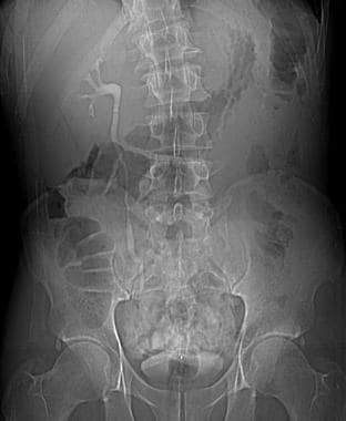 Kidney trauma. Grade 3 renal laceration on abdomin