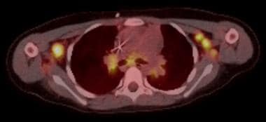 Axial PET-CT imaging in the same patient reveals e