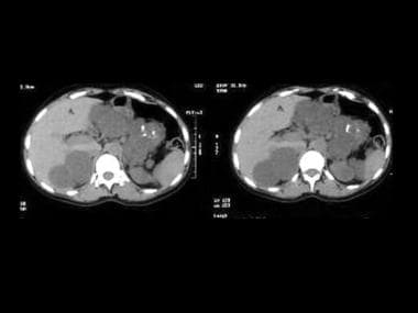 Axial upper abdominal CT scans unenhanced and enha