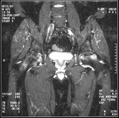 Coronal T2-weighted MRI of the same patient as in 
