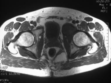 T1-weighted axial MRI of the pelvis demonstrates t