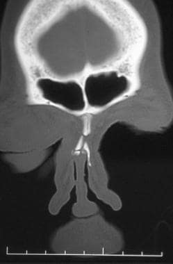 Nasal fractures. Coronal CT scan demonstrates a na