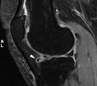 Sagittal T2-weighted image of the knee demonstrate