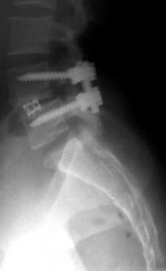 Lateral lumbar spine radiograph shows postoperativ